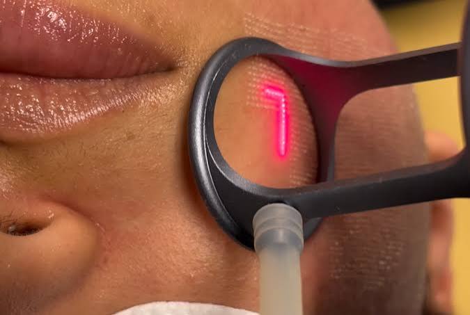 Fractional CO2 Laser Treatment