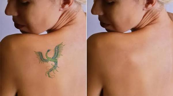 Tattoo Removal Before and After